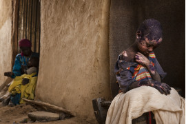 fot. Adriane Ohanesian, Sudan, 7-letni Adam Abdel ciężko poparzony podczas ataków lotniczych przeprowadzonych przez armię Sudanu Południowego w regionie Darfur