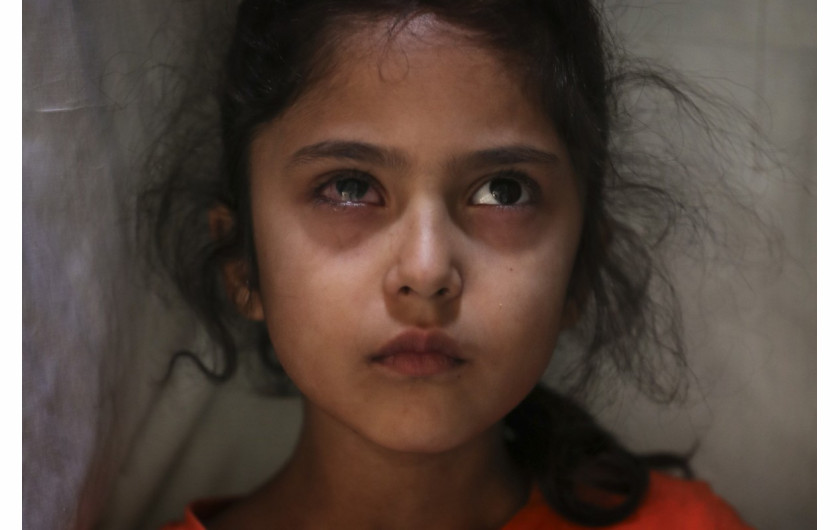 fot. Mukhtar Khan. 6-letnia Muneefa Nazir, która rzekomo została postrzelona marmurową kulą przez indyjski oddział paramilitarny 12 sierpnia. 17 września 2019 / The Pulitzer Prize 2020 for Feature Photography