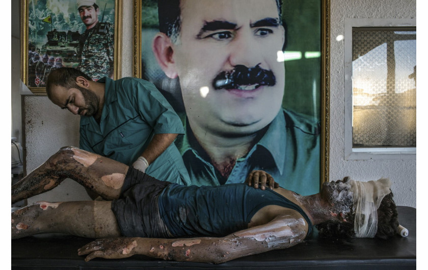 1. miejsce w kategorii General News, fot. Mauricio Lima // Bojownik SIS opatrywany w kurdyjskim szpitalu