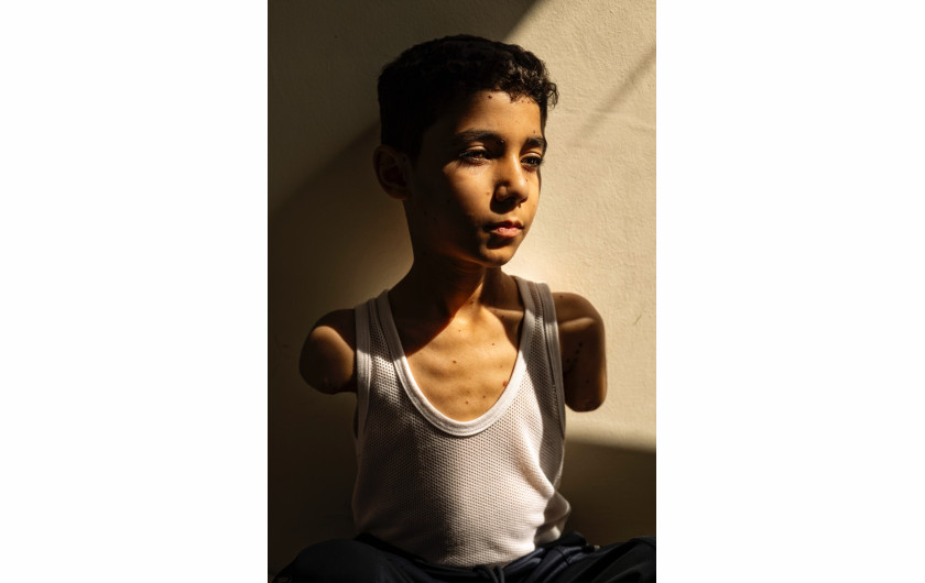 Fot. Samar Abu Elouf, for The New York Times, Mahmoud Ajjour, Aged Nine, nagroda w kat. regionalnej West , Central & South Asia / World Press Photo 2025Fotografka Samar Abu Elouf  została ewakuowana ze Strefy Gazy w grudniu 2023 roku. Obecnie mieszka w tym samym kompleksie apartamentów co Mahmoud w Doha, gdzie udokumentowała kilku ciężko rannych Gazańczyków. Doha, Katar, 28 czerwca 2024 r.
Mahmoud Ajjour został poważnie ranny podczas ucieczki przed izraelskim atakiem w mieście Gaza w marcu 2024 roku. Gdy zawrócił, by ponaglić swoją rodzinę, eksplozja oderwała mu jedną rękę i okaleczyła drugą. Rodzina została ewakuowana do Kataru, gdzie po leczeniu Mahmoud uczy się grać w gry na telefonie, pisać i otwierać drzwi stopami. Marzenie Mahmouda jest proste: chce otrzymać protezę i żyć jak każde inne dziecko. Wojna w Strefie Gazy zebrała nieproporcjonalne żniwo wśród dzieci. ONZ szacuje, że do grudnia 2024 r. w Gazie odnotowano największą na świecie liczbę dzieci z amputowanymi kończynami w przeliczeniu na jednego mieszkańca.