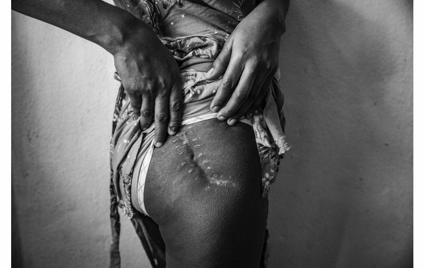 Z cyklu: Women's Bodies as Battlefields
fot. Cinzia Canneri / Association Camille Lepage / World Press Photo 2025



W 2017 roku Cinzia Canneri rozpoczęła dokumentowanie doświadczeń Erytrejek uciekających przed represyjnym reżimem swojego kraju. Po wybuchu wojny w regionie Tigraj w północnej Etiopii w 2020 roku, jej projekt rozszerzył się o historie kobiet z Tigraju, które zmuszone były opuścić swoje domy w wyniku zbrojnej inwazji. Obie grupy stały się celem systematycznej przemocy seksualnej – gwałtów, postrzałów, tortur – o której, z powodu społecznego tabu, ograniczonego dostępu do opieki zdrowotnej i trudności w dotarciu do ofiar, media informują zbyt rzadko. Ukazując historie i głosy ocalałych, projekt ten na nowo definiuje pojęcie odporności – jako złożonego, zbiorowego wysiłku w walce z bólem, traumą i stratą.